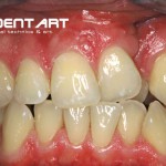 Herausnehmbarer Zahnersatz