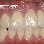 Herausnehmbarer Zahnersatz