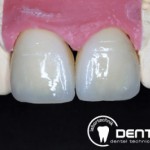 Festsitzender Zahnersatz