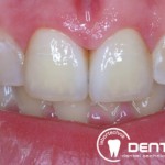 Festsitzender Zahnersatz