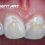 Festsitzender Zahnersatz