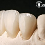 Festsitzender Zahnersatz