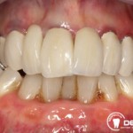 Festsitzender Zahnersatz