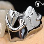 Festsitzender Zahnersatz