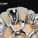 Festsitzender Zahnersatz