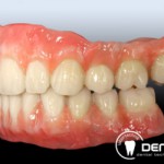 Festsitzender Zahnersatz