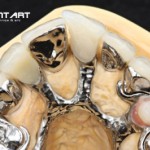 Festsitzender Zahnersatz