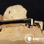 Festsitzender Zahnersatz