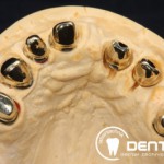 Festsitzender Zahnersatz