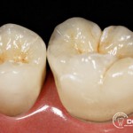 Herausnehmbarer Zahnersatz