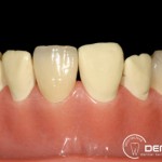 Herausnehmbarer Zahnersatz