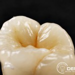 Herausnehmbarer Zahnersatz