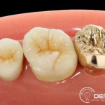 Herausnehmbarer Zahnersatz